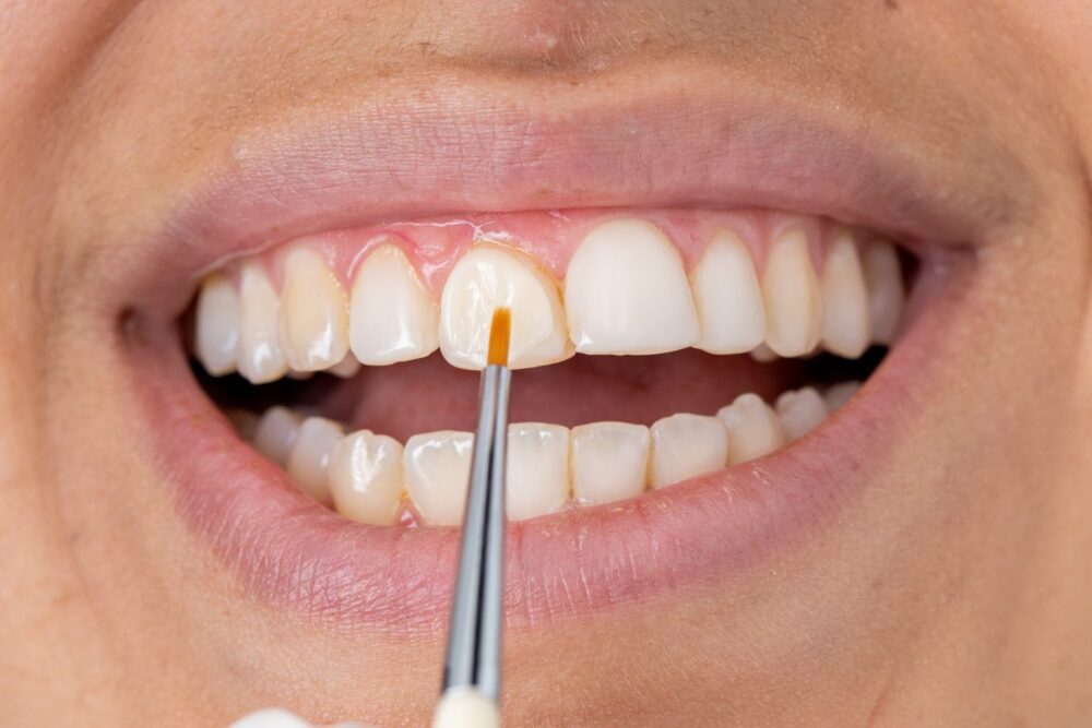 Kompozitné bondovanie